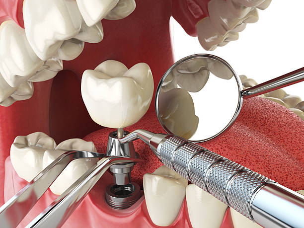 Best Emergency Tooth Extraction in Maple Plain, MN